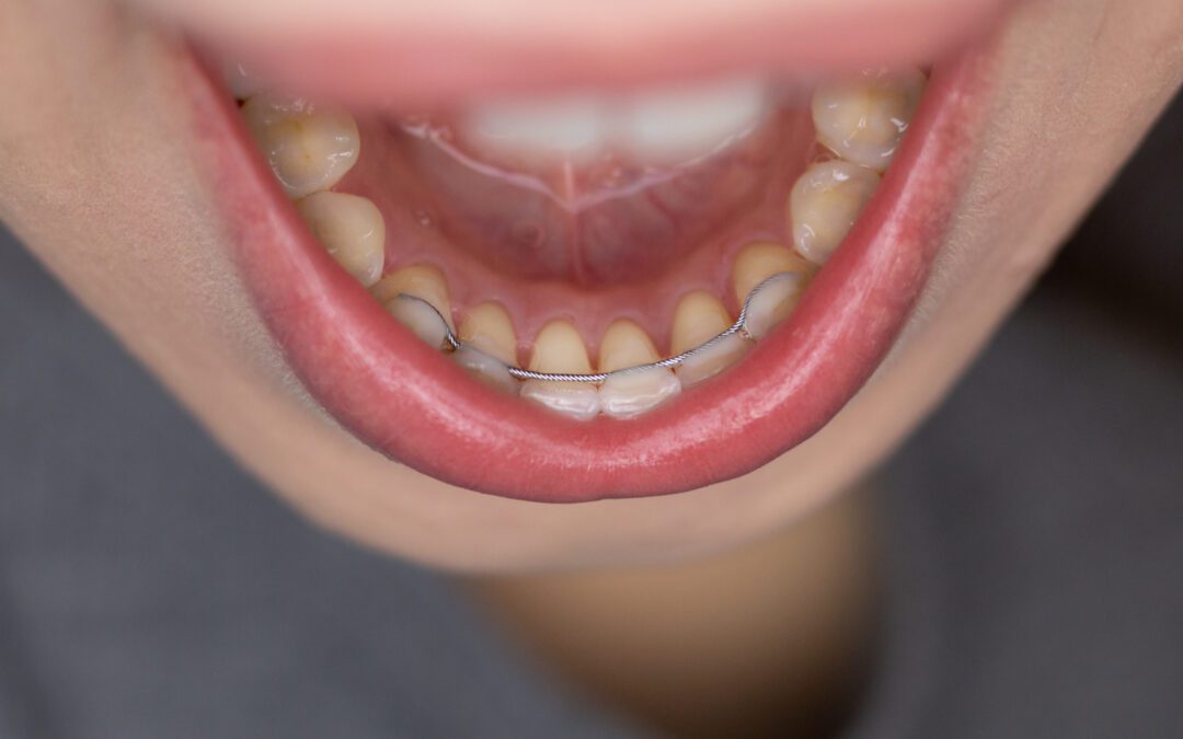 What to Do If You Have a Broken Permanent Retainer