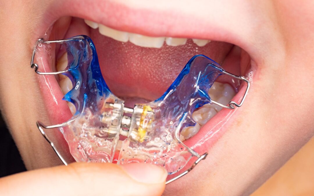 Palatal Expansion