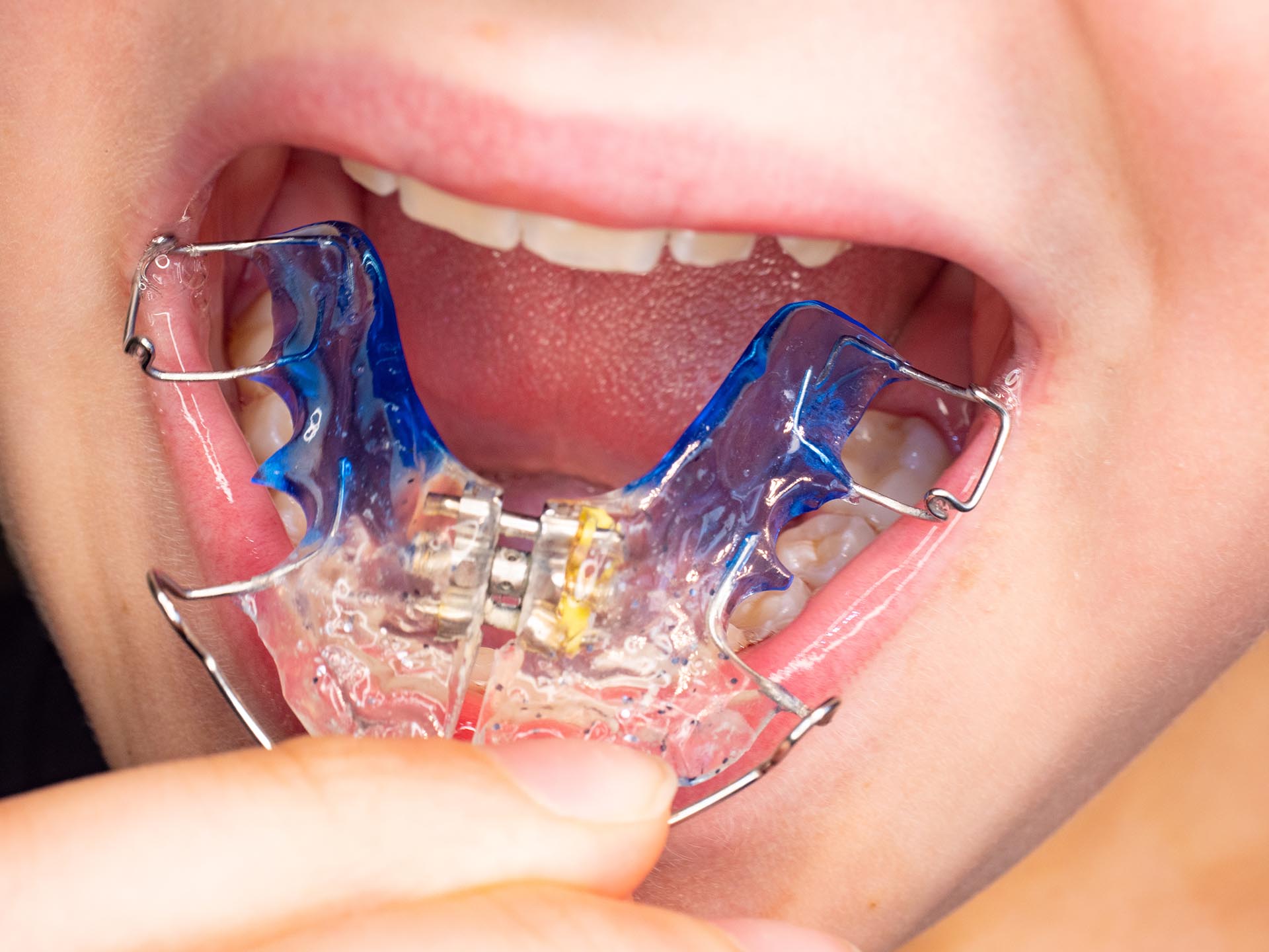 Palatal Expansion