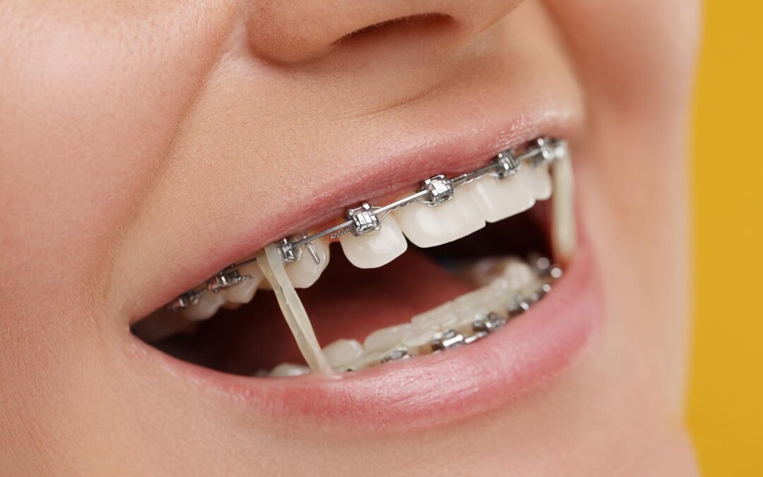 What Do Rubber Bands in Braces Do?