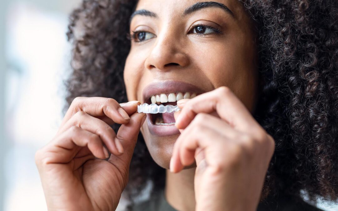 The Importance of Dental Fluoride When Wearing Invisalign