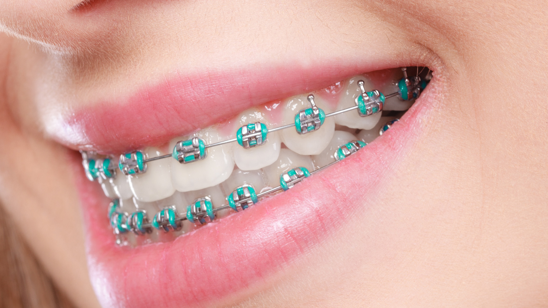 Can You Get Braces if You Have Crowns?