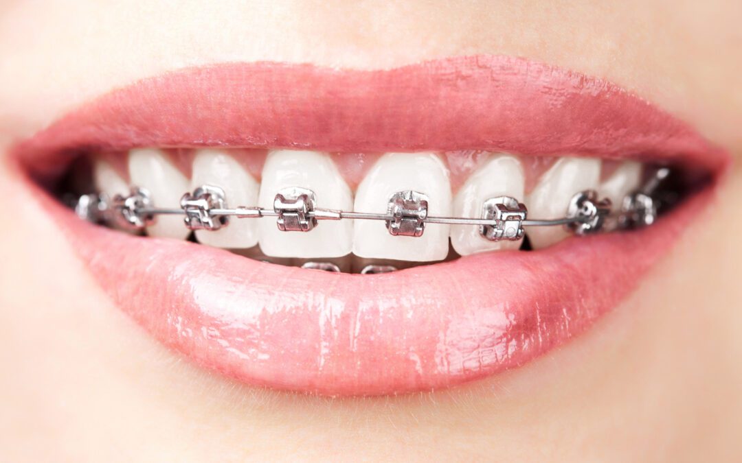 Can You Get Braces Without Insurance? Explore Your Options