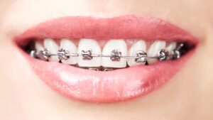 can you get braces without insurance