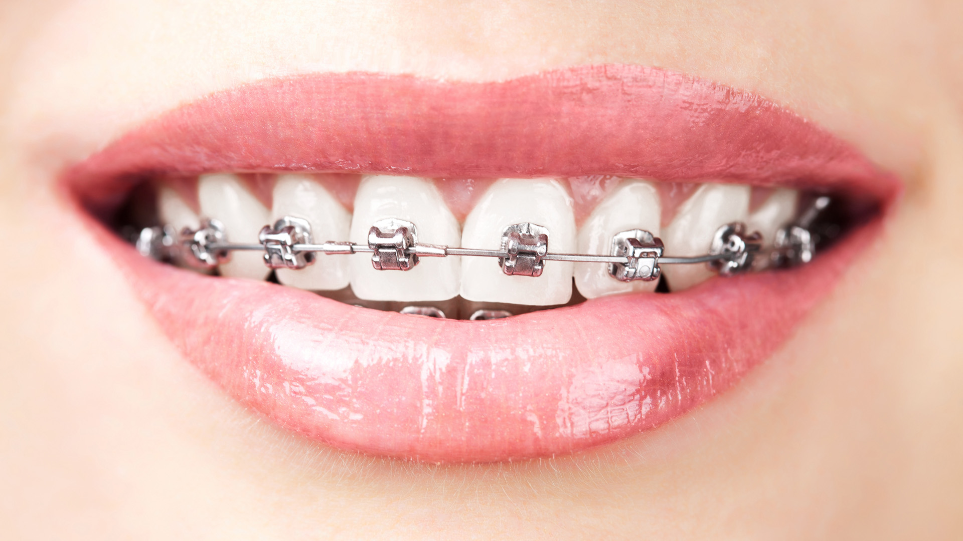 Can You Get Braces Without Insurance? Explore Your Options