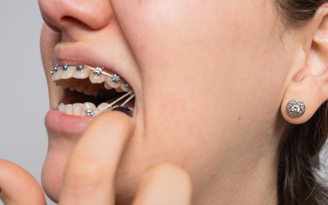 Exploring the Types of Rubber Bands Braces Use