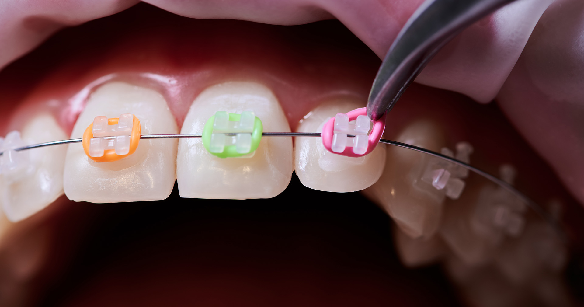 Braces Colors Picker | Design Your Look Online