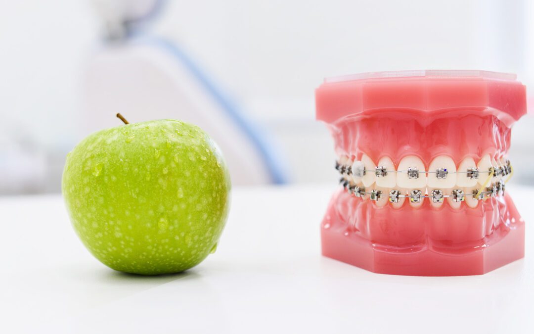 Braces Friendly Food: What to Eat and Avoid