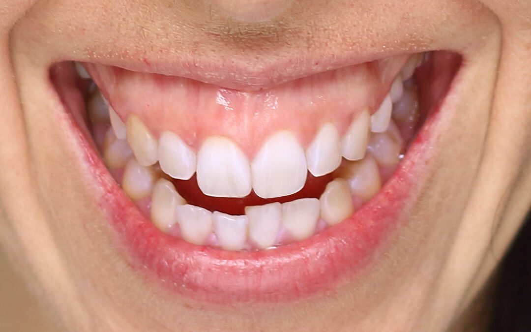 How to Fix a Gummy Smile: A Comprehensive Guide