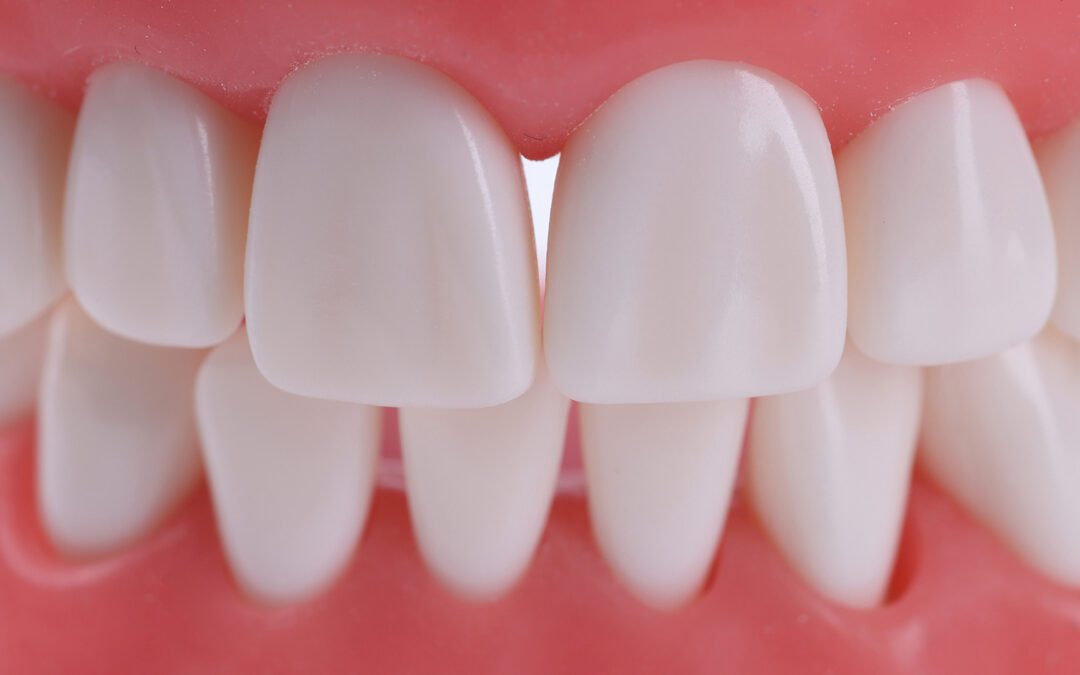 What Does a Perfect Bite Alignment Look Like?