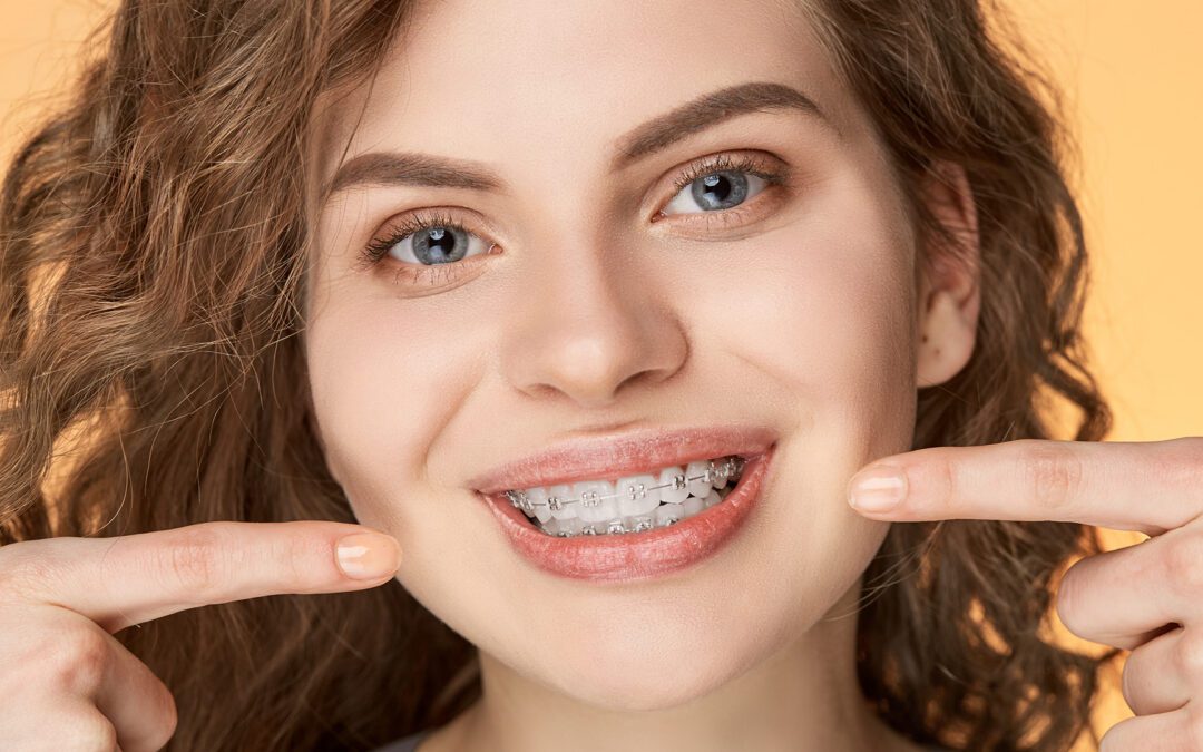 What to Know About Getting Braces