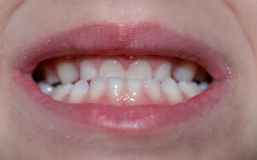 How Do You Fix an Underbite?