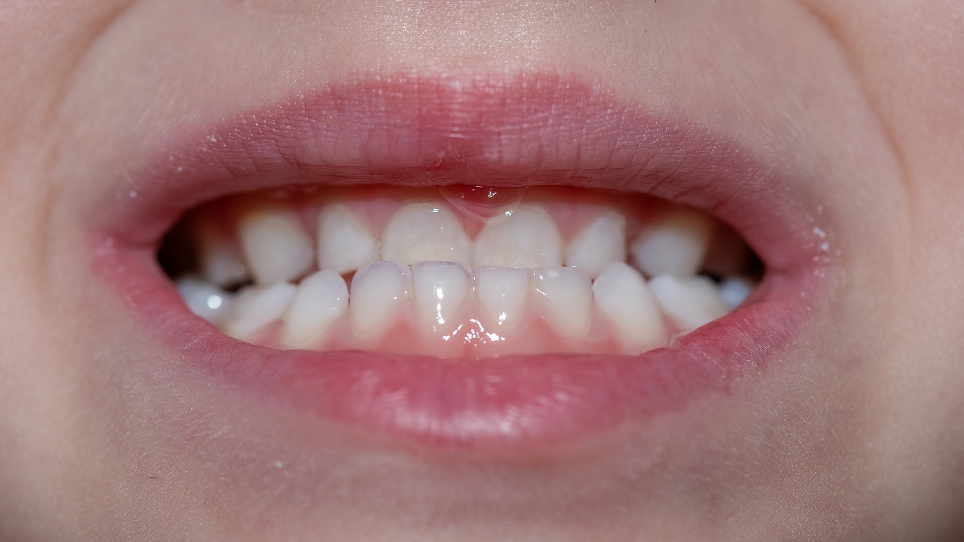 How Do You Fix an Underbite?