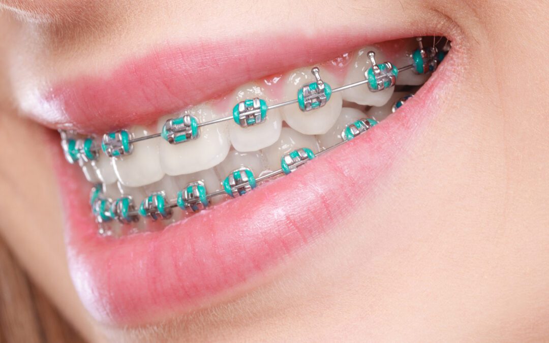 Bite Correction: What It Is and How It Improves Your Smile