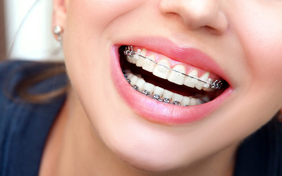 Ceramic Braces: Pros and Cons