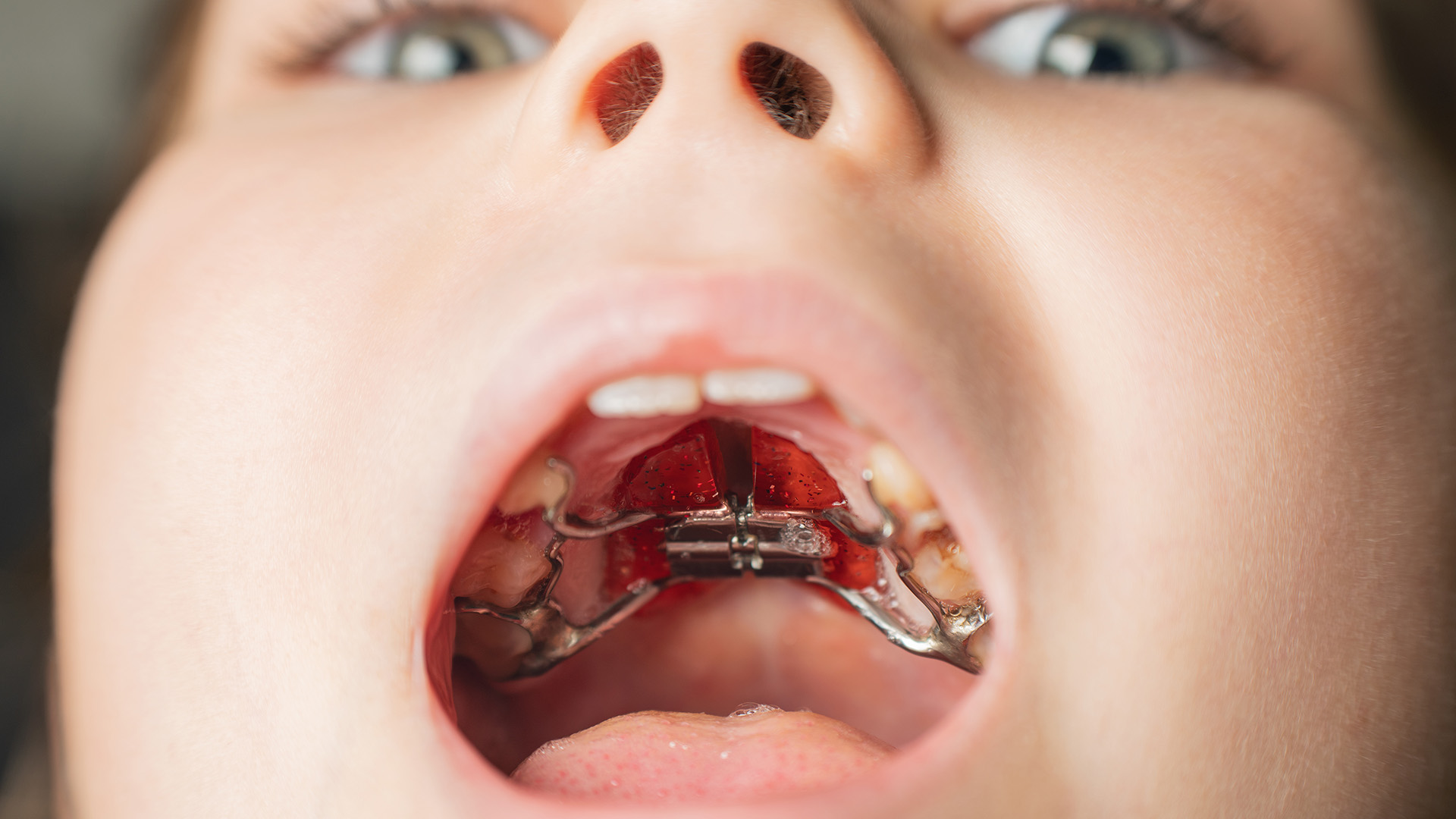 What Is a Rapid Palatal Expander?