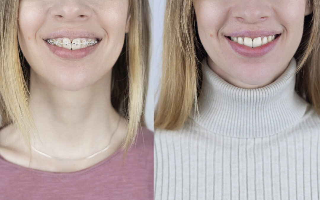 Invisible Dental Braces: Clear, Comfortable Options for a Confident Smile
