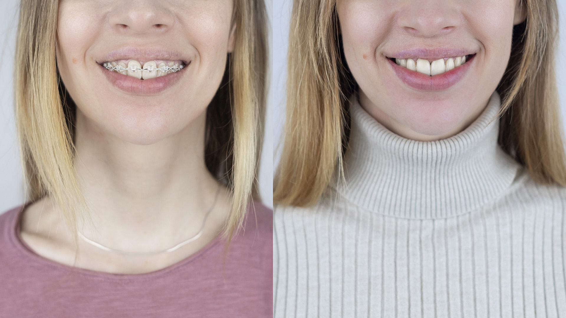 Invisible Dental Braces: Clear, Comfortable Options for a Confident Smile