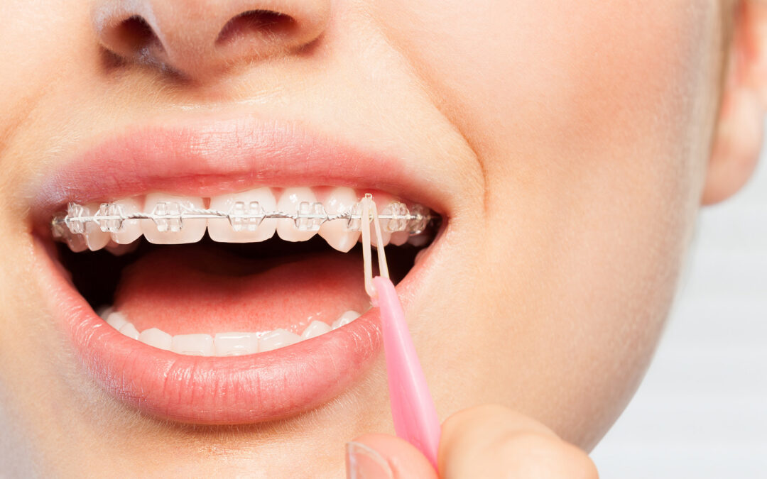 What Do Triangle Rubber Bands on Braces Do?