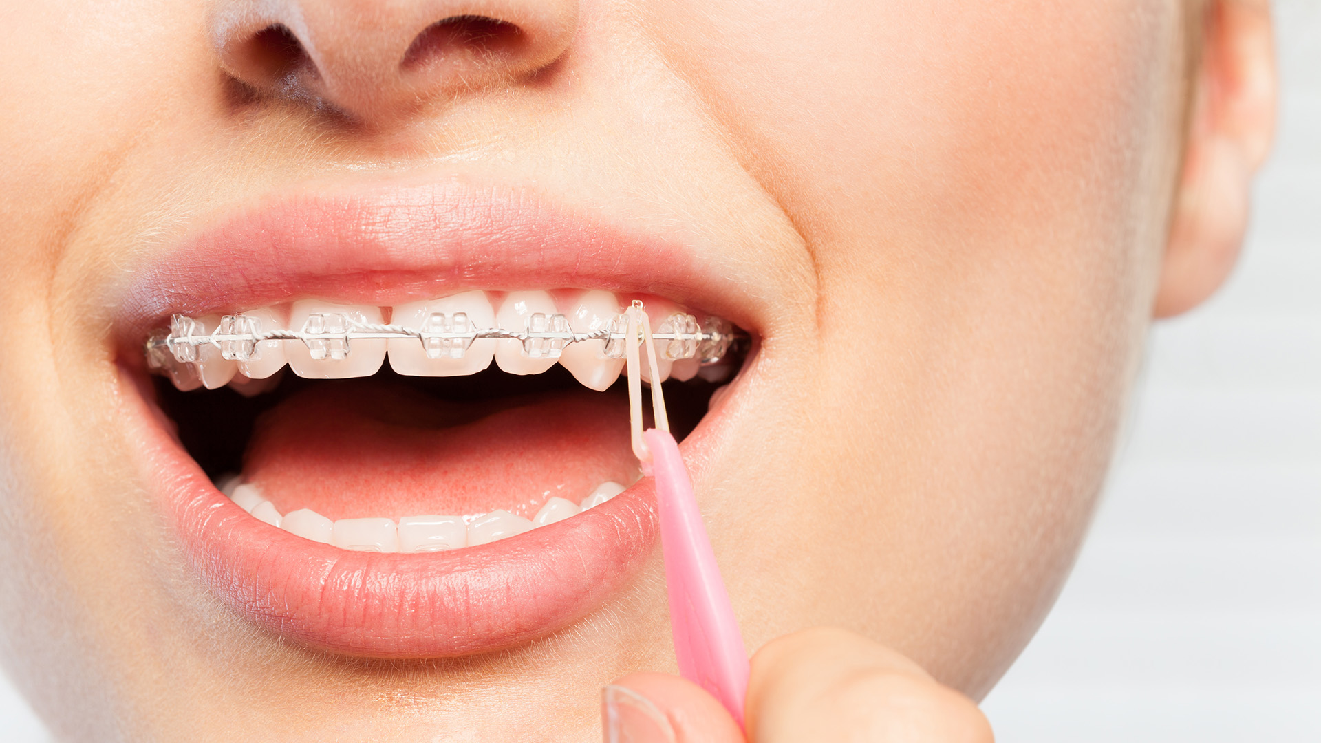 What Do Triangle Rubber Bands on Braces Do?